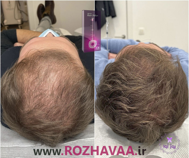 هیر فیلر مو دکتر سی وای جی Hair Filler Dr.Cyj اصل ساخت کره